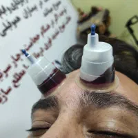 60 نوع حجامت تخصصی و انواع بادکش
