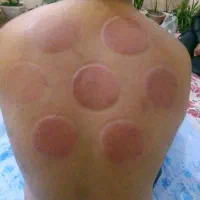 حجامت معجزه میکنه|آرایشی، بهداشتی، درمانی|بندر کنگان, |دیوار