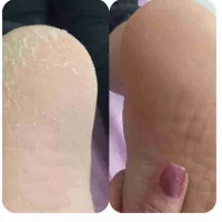 پدیکور تخصیصی رفع ترک پا