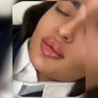 ژل لب 850بوتاکس کل صورت ۷۵۰(پزشک متخصص)