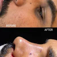 آف ویژه زیبایی بینی|خدمات آرایشگری و زیبایی|بهبهان, |دیوار