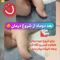 بهبود زگیل/تبخال/hpv/hsv|آرایشی، بهداشتی، درمانی|قم, یخچال قاضی|دیوار