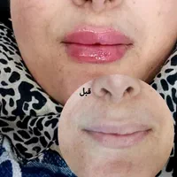 زیبایی ژل و بوتاکس|خدمات آرایشگری و زیبایی|اهواز, کیان اباد|دیوار