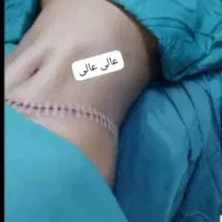 لیپوساکشن ،پیکرتراشی، جراحی زیبایی ،ابدومینوپلاستی|خدمات آرایشگری و زیبایی|تهران, شهرآرا|دیوار