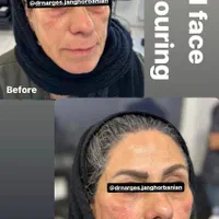جشنواره تزریق ژل و بوتاکس|خدمات آرایشگری و زیبایی|اصفهان, دانشگاه اصفهان|دیوار