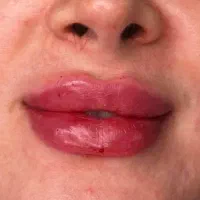 بوتاکس‌ فیلر مزو پی آر پی جوانساز لیفت با نخ آنزیم