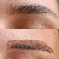 ریموو تخصصی تک جلسه ای
