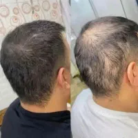خداحافظی با ریزش مو در یک دوره ۱۰۰٪ گیاهی و تضمینی|آرایشی، بهداشتی، درمانی|مشهد, راهنمایی|دیوار