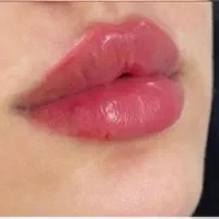 کانتورصورت ژل لب آنزیم بینی بوتاکس مزوژل جوانسازی