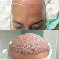 کاشت مو فول تراکم تضمینی|خدمات آرایشگری و زیبایی|گرگان, |دیوار