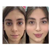 تخفیف ۵۰ درصدی فیلر و بوتاکس برای بانوان و آقایان