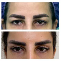 جشنواره بلفاروپلاستی