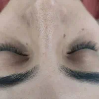 فیشال تخصصی پاکسازی۲۰۰تومان مزو کربوکسی اسیدتراپی|خدمات آرایشگری و زیبایی|مشهد, هدایت|دیوار
