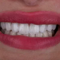 دندانپزشکی،ایمپلنت دیجیتال،اوردنچر،کامپوزیت،لمینت