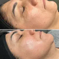 انجام خدمات حرفه ای پاکسازی و فیشال صورت