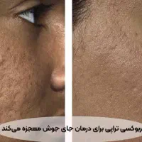 کربوکسی تراپی|خدمات آرایشگری و زیبایی|رفسنجان, |دیوار