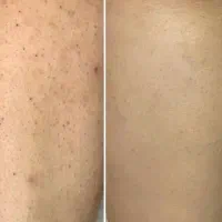 تنها لیزر موی تضمینی سبزوار