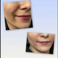 جشنواره تزریق بوتاکس وژل. فیلرکل صورت از ۷میلیون|خدمات آرایشگری و زیبایی|بردسیر, |دیوار