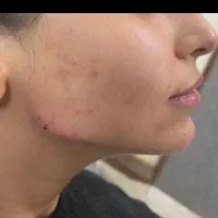 آموزش و تزریق ژل و بوتاکس ومزو|خدمات آموزشی|شیراز, تندگویان|دیوار