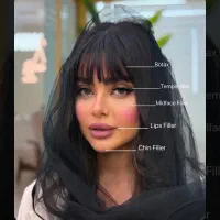 تخفیف استثنایی ژل و بوتاکس با شرایط پرداخت عالی