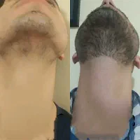 ریش سبیل با نورون درمانی