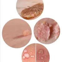 رفع دائمی زگیل وتبخال|آرایشی، بهداشتی، درمانی|مرند, |دیوار