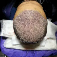 کاشت مو و ابرو|آرایشی، بهداشتی، درمانی|کرج, دانشگاه هنر تهران (پردیس کرج)|دیوار