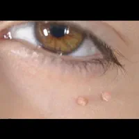 زگیل تناسلیhpv/میخچه/زیگیل/خال/اسکین تگ خالبرداری|خدمات آرایشگری و زیبایی|تهران, علم و صنعت|دیوار