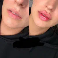 جشنواره تخفیفی تزریقات،کربن، ژل و بوتاکس،لیزر|خدمات آرایشگری و زیبایی|بندرعباس, |دیوار