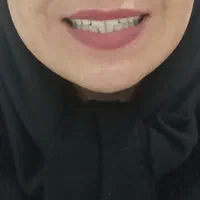دندانسازی ( پروتز متحرک) لمینتی و کامپوزیتی|خدمات آرایشگری و زیبایی|مشهد, احمدآباد|دیوار