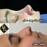 جراحی بینی با ضمانت نامه کتبی کیفیت