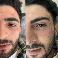 حذف پف پلک و افتادگی بوتاکس،ژل،بوکال،سانترال،هایفو|خدمات آرایشگری و زیبایی|تبریز, |دیوار