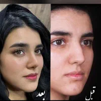 عمل زیبایی بینی در مازندران با کمترین مبلغ