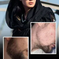 رویش و کم پشتی ریش