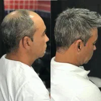 پروتز مو و ترمیم مو