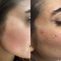 اینو بزن تمامی لکه های پوستی رو نابود کن