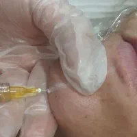 ژل سی سی 550  فیلر لب و گونه چانه و بوتاکس650|خدمات آرایشگری و زیبایی|قم, شهرک توانیر|دیوار