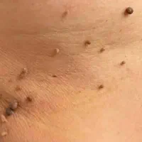 برداشت خال گوشتی (منگوله پوستی ) (اسکین تگ)