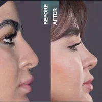 کامپوزیت لمینت ایمپلنت جراحی بینی بلفارو ساکشن|خدمات آرایشگری و زیبایی|مشهد, سجاد شهر|دیوار