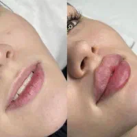 ژل لب گونه چونه زاویه خدمات پرسینگ