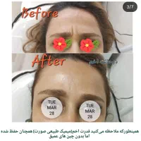 بوتاکس طبیعی|خدمات آرایشگری و زیبایی|رشت, منظریه|دیوار