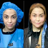 پیکرتراشی به روش باربی.لیپو ابدو سینه پرتز براکیو