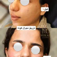 بوتاکس و ژل(فیلر)،بدون درد با ماندگاری بالا|خدمات آرایشگری و زیبایی|ارومیه, |دیوار