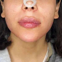 ژل لب فیلربینی مزو بوتاکس ژل بدن  ۳۹۹ آموزش پزشک|خدمات آرایشگری و زیبایی|فردیس, |دیوار