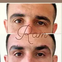 جراحی زیبایی لیفت صورت شقیقه ابرو پلک غبغب سانترا