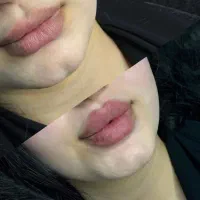 کلینیک تزریق ژل بوتاکس لیزرمو زائد کندلا ریموو تتو|خدمات زیبایی و سلامت|تهران, نیروی هوایی (پیروزی)|دیوار