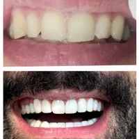 دندانپزشکی شاین . ترمیم دندان . کامپوزیت|خدمات آرایشگری و زیبایی|بابل, |دیوار