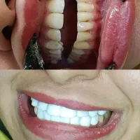 فقط با فکی ۶ تومن دندوناتو کامپوزیت کن
