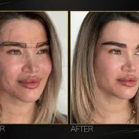 کاشت ابروهای پرپشت و طبیعی در شهر قدس بدون جراحی
