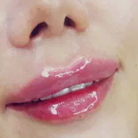 ژل لب،فیلر بوتاکس لیزر موهای زاید درمجموعه پزشکی